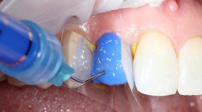 Mouth syndrome causes symptoms bms gerd pressidium